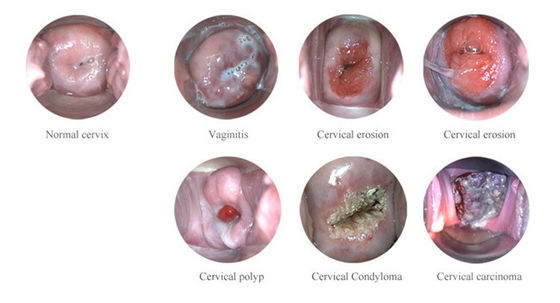 পোর্টেবল ডিজিটাল ইলেকট্রনিক কলপোস্কোপ