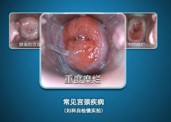 ডিজিটাল এন্ডোস্কোপ স্ব-পরিদর্শন কলপোস্কোপ মিনি পর্যবেক্ষণের পরিসীমা সহ 100 p 100 মিমি