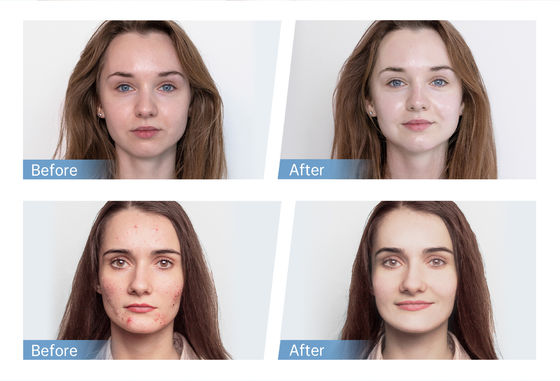 সর্বশেষ ৪-মেরু ইএমএস স্বয়ংক্রিয় সিরাম অ্যাপ্লিকেটর হাইড্রা পেন এইচ৫ ফেস স্কিন ডার্মা মাইক্রোনিডলিং পেন এসেন্স কোলাজেন পুনর্জন্ম