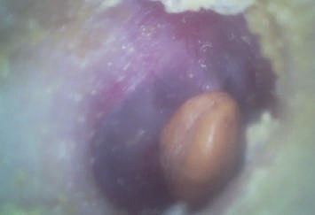 পোর্টেবল ইএনটি স্কোপ ইকোনমিক হ্যান্ডহেল্ড ডিজিটাল ভিডিও অটোস্কোপ 32 জি মাইক্রো এসডি ফ্ল্যাশ কার্ড সহ